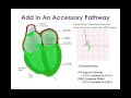 Wolff-Parkinson-White (WPW) and Associated Arrhythmias