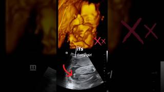Its baby Girl ? baby pregnancy ultrasound shorts