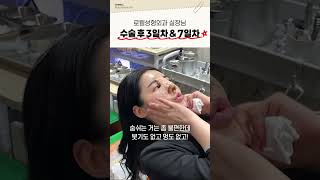 코재수술 3일차&amp;7일차 찐후기😮  #로웰성형외과 #코수술 #코성형 #코재수술 #코수술재료 #자가늑연골 #기증늑연골 #강남성형외과 #코수술잘하는곳