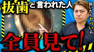 【簡単に抜歯しちゃダメ】抜かずに治せる歯を見極める方法はコレ。根管治療なら歯医者で抜歯と言われた歯も残せます！