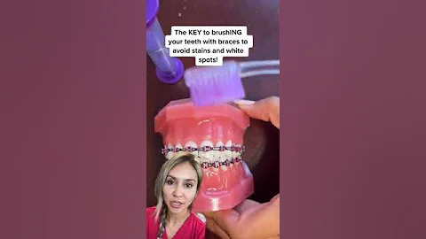 How to Brush With Braces to Avoid White Spots
