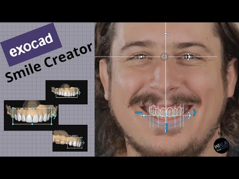 Exocad - Smile