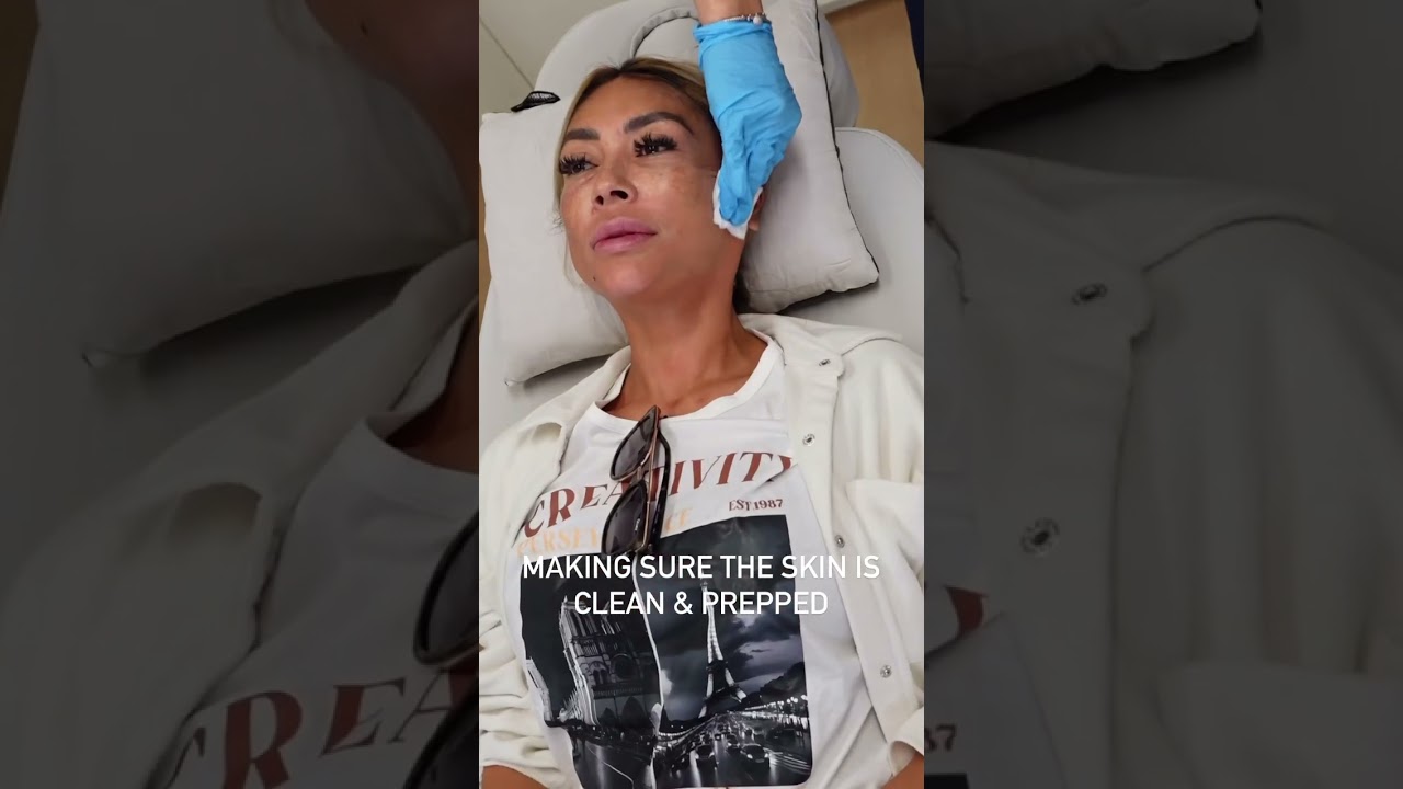 Newport Beach Coolpeel Laser Treatment- Skinsation OC