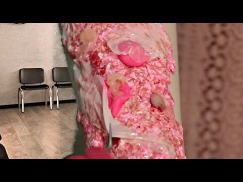 ASMR: CUIDANDO DA SUA QUEIMADURA 👩🏻‍⚕️ (vídeo satisfatório)