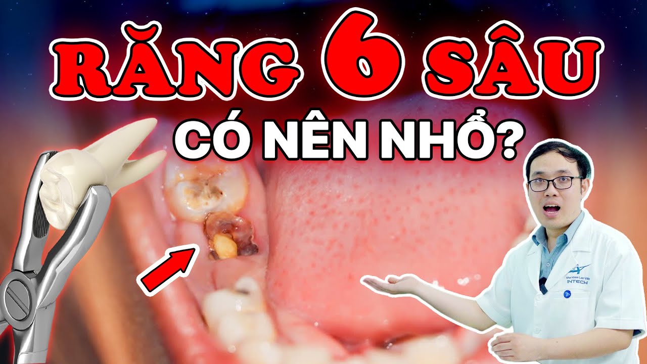 Outline Video Răng Số 6 Bị Sâu Có Nên Nhổ Không? 6 Trường Hợp Không Thể Cứu, Bắt Buộc Phải Nhổ!