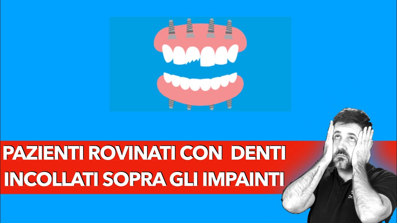 Pazienti curati male con impianti e denti incollati
