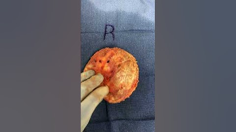Breast Implant Illness Miami Surgeon Displays Removed Implants WARNING GRAPHIC