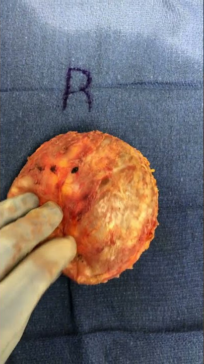 Breast Implant Illness Miami Surgeon Displays Removed Implants WARNING GRAPHIC