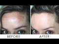 How I Got Rid Of Pigmentation / Melasma | Shonagh Scott