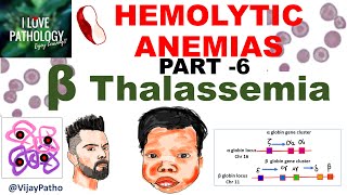 Hemolytic Anemias- Part 6: Beta Thalassemia- Pathogenesis, types, Diagnosis & Treatment