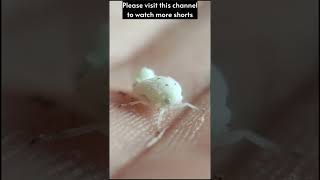 Planthopper Insects On My Hand