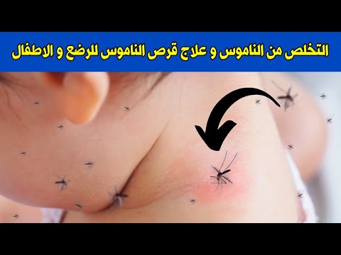 فيديو: كيفية تشويه لدغات البعوض على طفل صغير