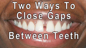 How can I close my teeth gap at home?