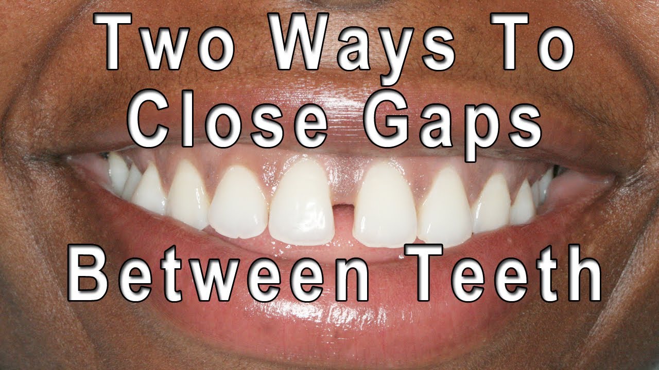 How Much To Fix Teeth Gap