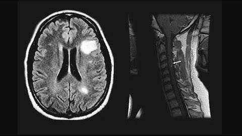 Multiple Sclerosis and the Upper Cervical spine