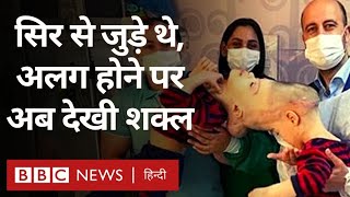 Conjoined Twins : सिर से जुड़े जुड़वा बच्चों ने जब पहली बार एक-दूसरे को देखा (BBC Hindi)