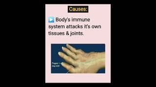 ▶️ Part 3  RHEUMATOID-ARTHRITIS #bansal_physio_therapy ✅️ONLINE-ONLINE-TELE PHYSIOTHERAPY