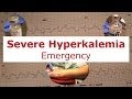 Severe hyperkalemia emergency