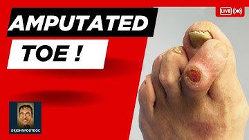 Amputation of a 2nd Toe