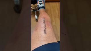 My total knee replacement was done on monday, june eighth and recovery has been a Breeze