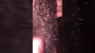 #hairgrowth #asmrtriggers #asmrhair #ingrownhairremoval #removeingrown #satisfying #blackheads