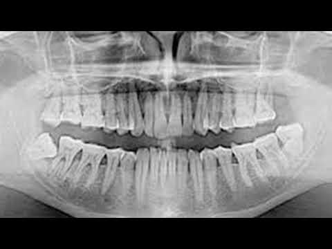 Vídeo: Crescer Novos Dentes Em 9 Semanas: Um Procedimento Que é Possível Em Qualquer Idade! - Visão Alternativa