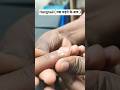 (hangnail) तुतुना निकलने के बाद पस पढ़ना #mbbs #nursing #nurse #doctor #motivation #viral #video #iv