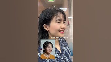 Niềng răng hết cười hở lợi và hết hô