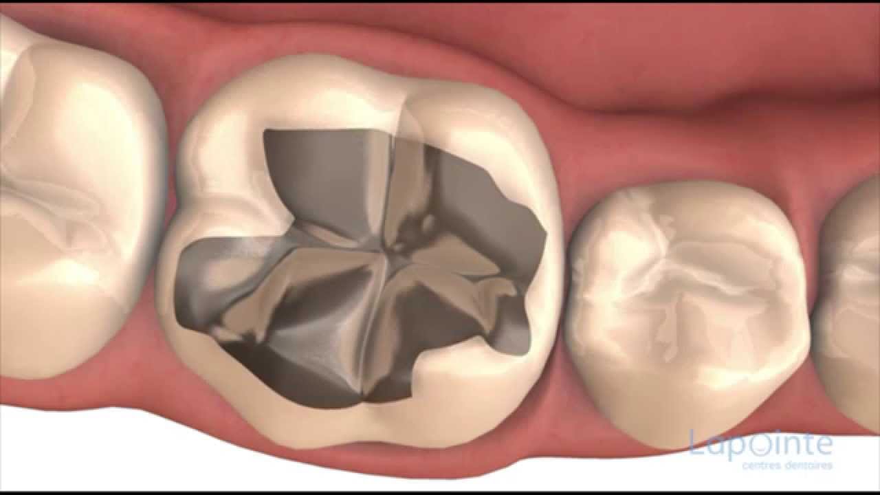 Amalgame - Centres dentaires Lapointe 