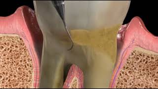 Laser Assisted Periodontal Therapy