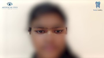 Artificial Eye (Left) vs Natural Eye (Right) | Ocular Prosthetic Movement Demonstration