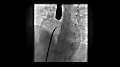 LV Angiogram profiling perimembranous VSD prior to closure with PDA occluder