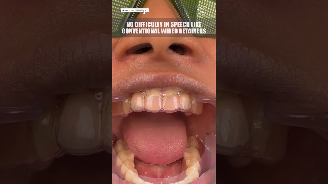 Essix Retainers After Dental #braces | Is It At All Important - #orthodontictreatment #dentalbraces