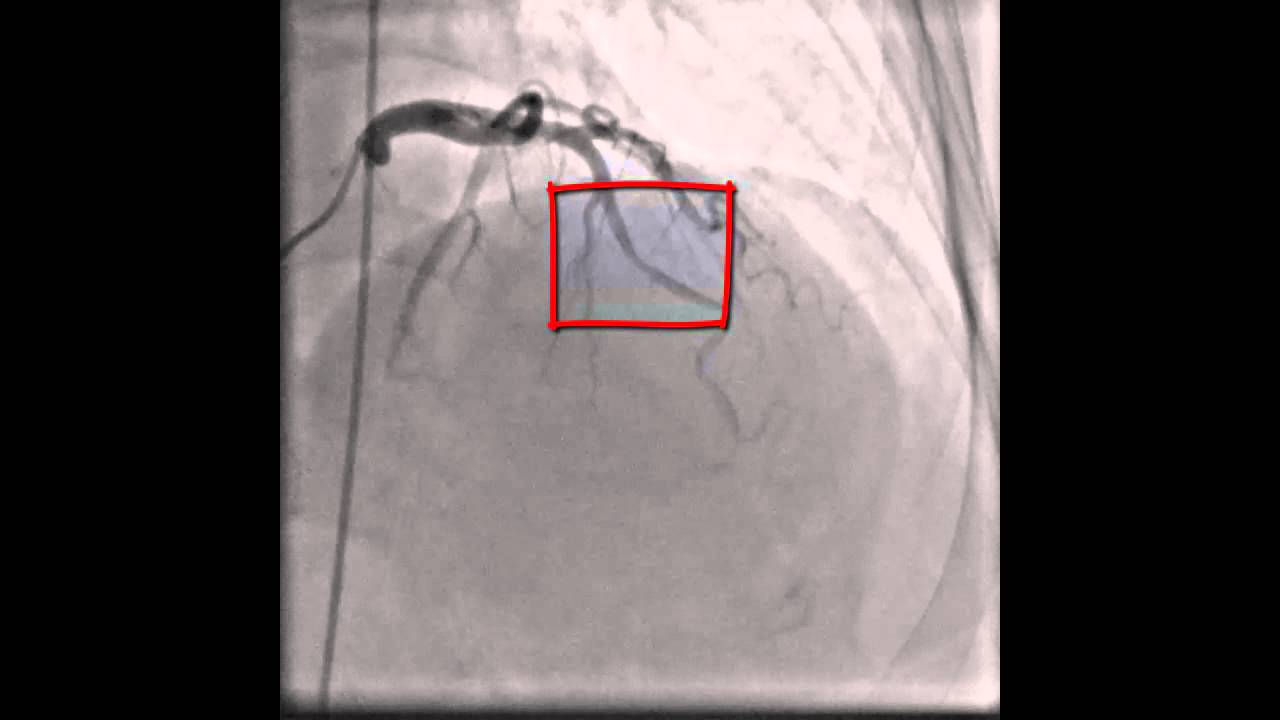 Heart coronary artery spasm YouTube