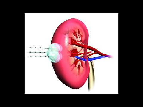 Video: Mushuklarda Buyrak Saratoni (adenokarsinoma)