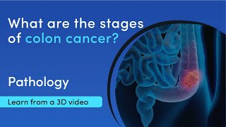 Colon cancer - stage 0 to stage 4 explained in a 3D video | MediMagic