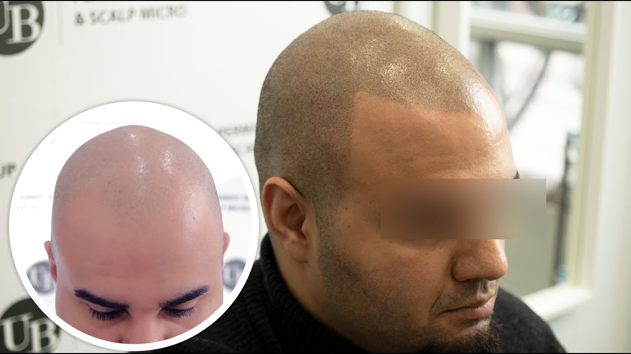 Reviewing Celebrity Scalp Micro pigmentation 2022  Celebrity Hair Tattoos