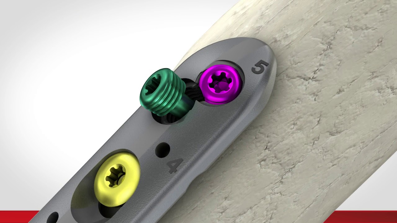 Proximal Humerus Plate System: PANTERA® Animation Illustration