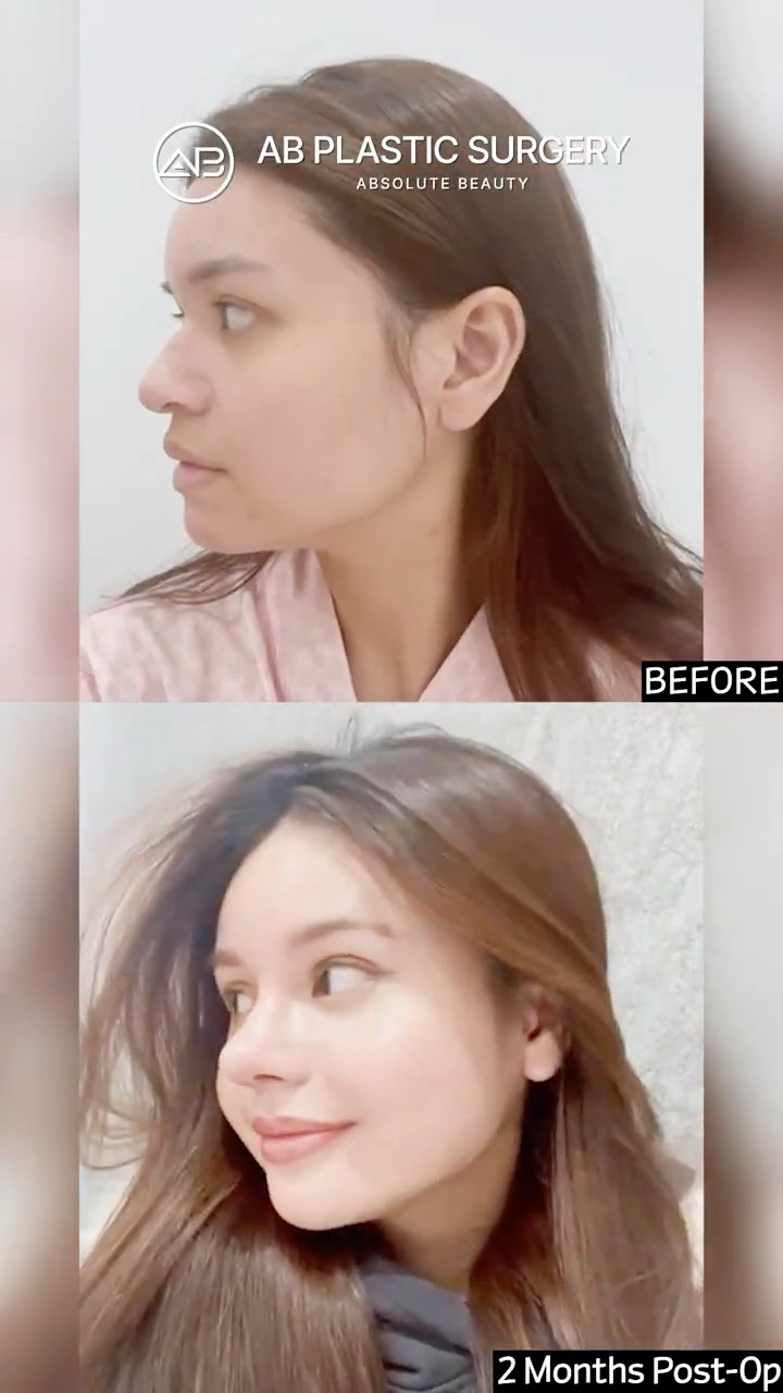 From Profile to Perfect ✨ Rhinoplasty Result #Shorts
