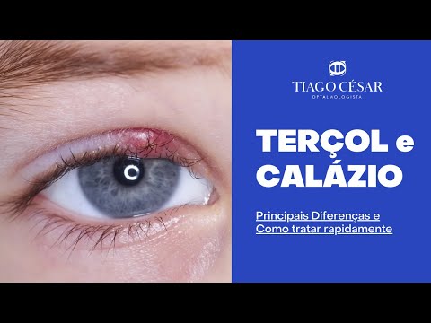 Calázio e hordéolo (terçol): Causas Sintomas e Tratamentos – EYECOLORS –  Vison Care