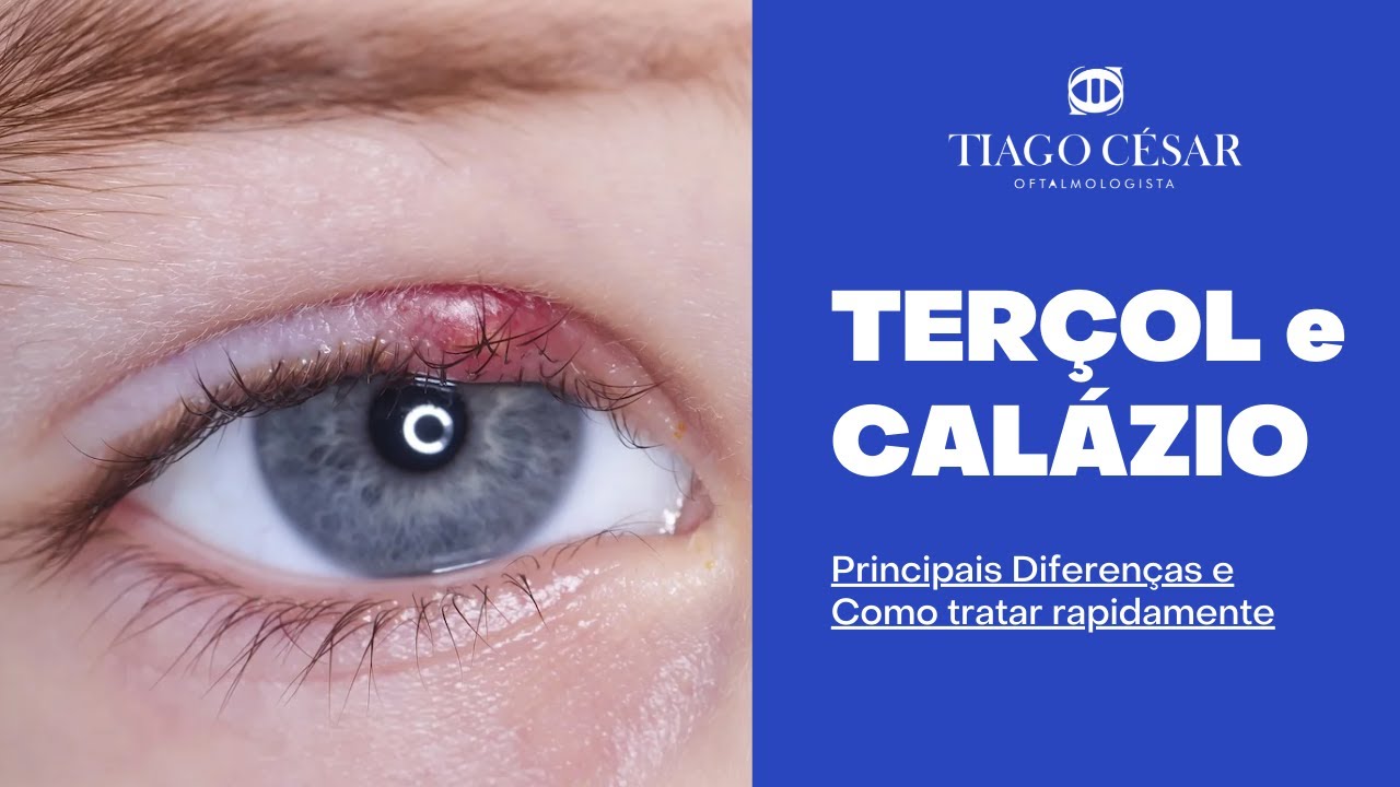 Blefarite, hordéolo e calázio: Entenda as diferenças - DermaVisus