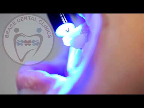 Dental Brackets