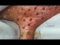 Severe cystic acne and blackheads removal