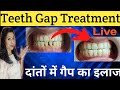 दांतों में गैप का इलाज |Teeth Gap Treatment Live |मसूड़े नीचे जाने का इलाज |Teeth Capping Process