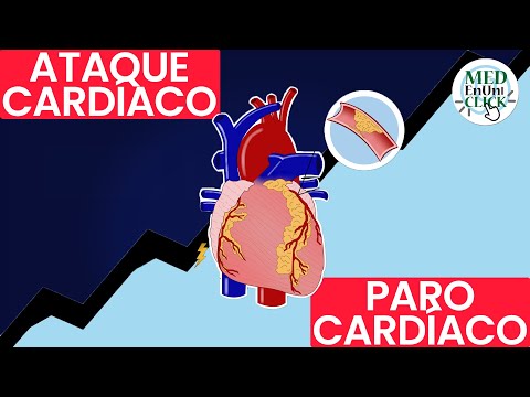 Video: 4 formas de diferenciar entre acidez y un ataque cardíaco