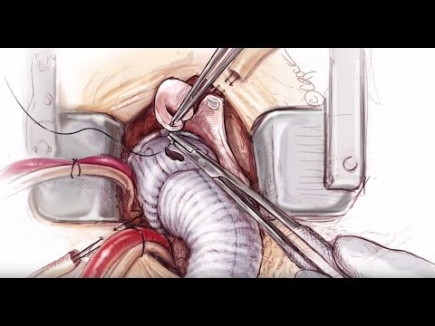 Mini Bentall Procedure And Hemiarch Replacement Coronary