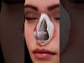 Letdown Preservation Classical Rhinoplasty ⭕️ KAMINSKYI