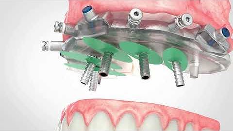 Ultimate Fully-Guided All-on-X: CHROME GuidedSMILE