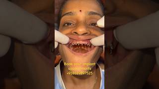 Full Mouth Dental Implant with Fix teeth #teeth #implantsurgery #mumbaidental #mumbai #shorts