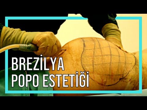 Brezilya Popo Estetiği